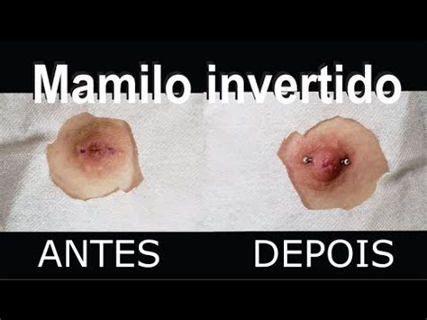 MAMILOS INVERTIDOS: O que é, quais são as causas,。